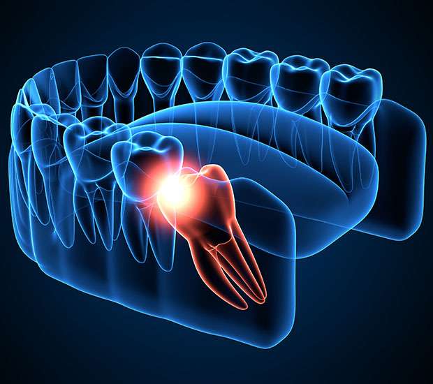 San Ramon Wisdom Teeth Extraction